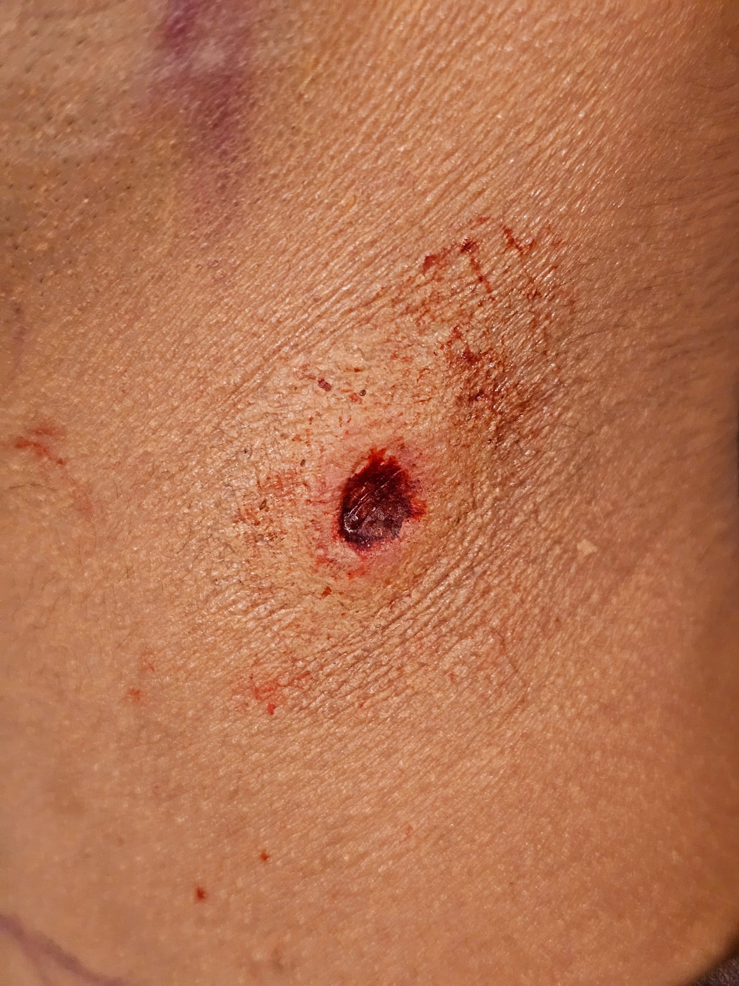 Gunshot Entry Prosthetic Transfer