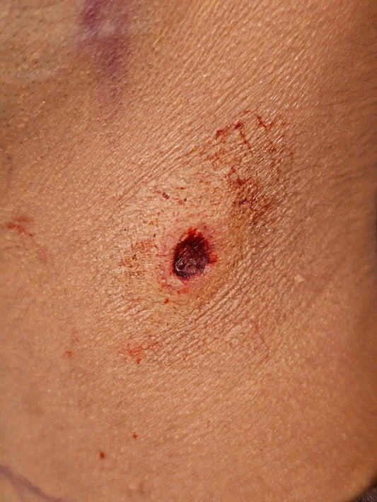 Gunshot Entry Prosthetic Transfer