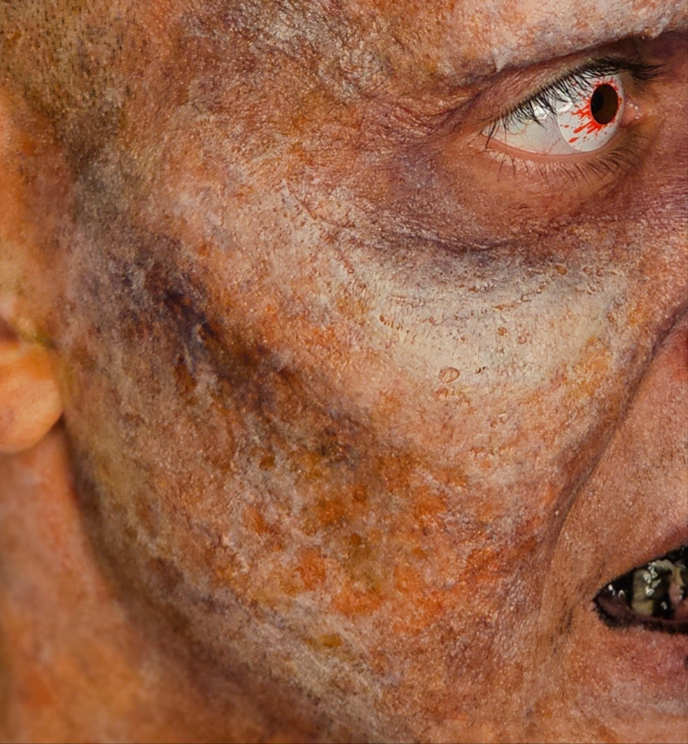 High Cheek Prosthetic Transfer