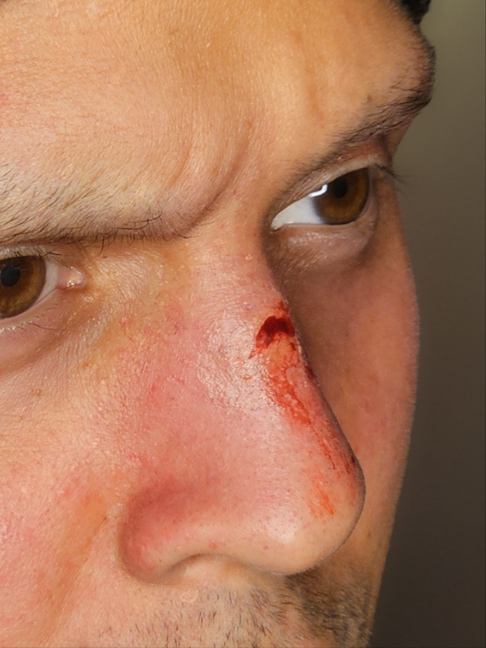 Nose scar 01 Prosthetic Transfer