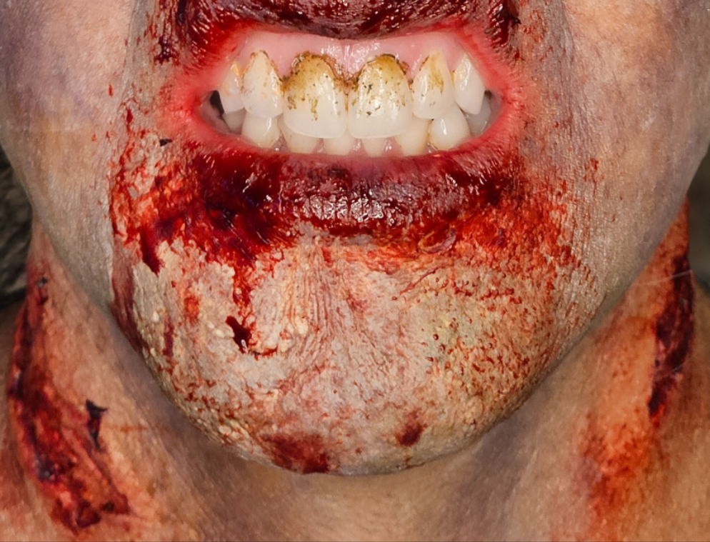 Zombie Chin Prosthetic Transfer