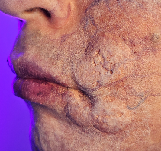 Bumps Prosthetic Transfer