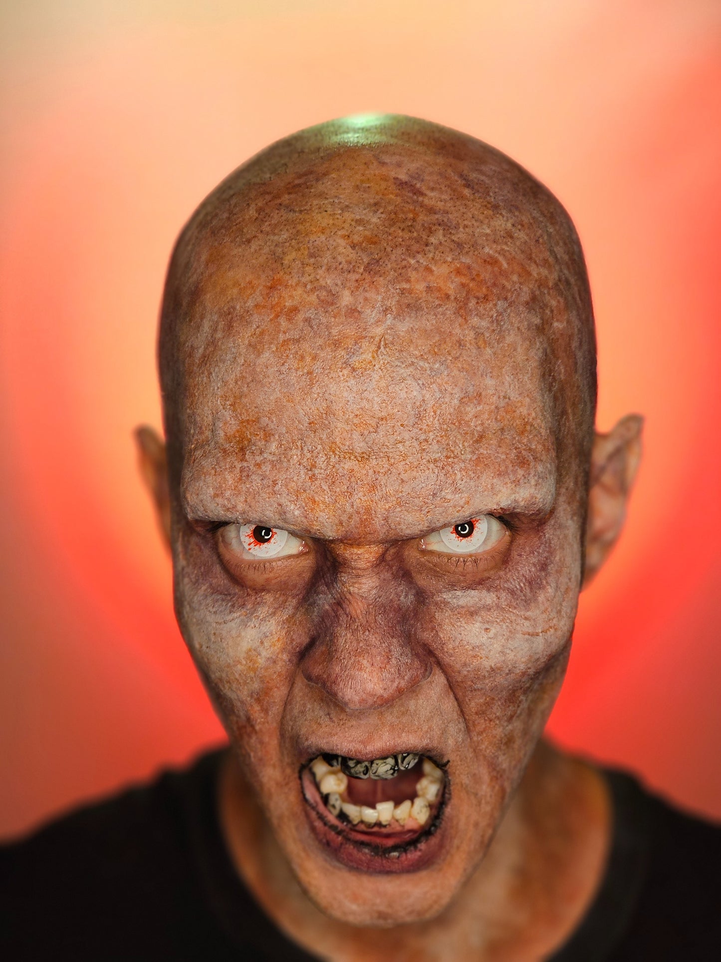 High Cheek Prosthetic Transfer