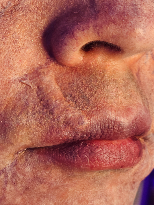 Lip Scar Prosthetic Transfer